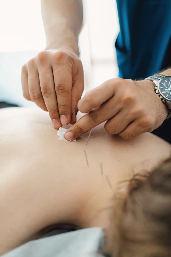 A woman receiving acupuncture treatment to relieve pain and enhance healing, showcasing medical acupuncture benefits.